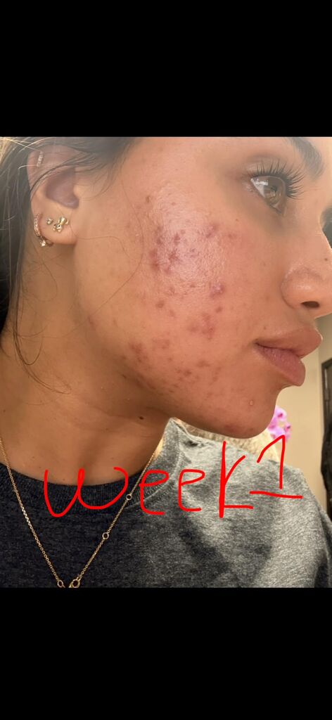 TruSkin Vitamin C Serum for Face - Anti Aging Face Serum with Hyaluronic Acid & Vitamin E - Brightening Formula - 1 fl oz customer photo 1