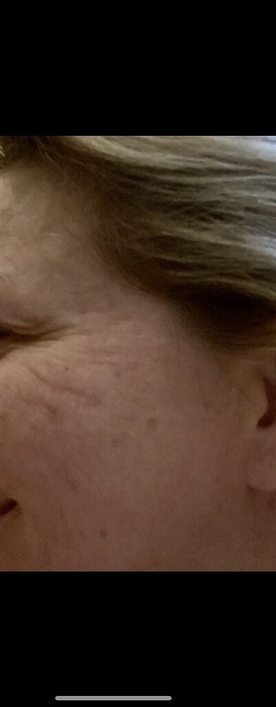 BLUMBODY Face, Forehead Wrinkle Patches - Anti Wrinkle Facial Patches to Smooth Eye, Mouth, Forehead Wrinkles - Non-Silicone Face Tape for Fine Wrinkles between Eyes, Face - Patches (30 day supply) customer photo 1