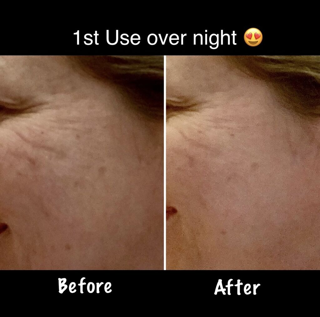 BLUMBODY Face, Forehead Wrinkle Patches - Anti Wrinkle Facial Patches to Smooth Eye, Mouth, Forehead Wrinkles - Non-Silicone Face Tape for Fine Wrinkles between Eyes, Face - Patches (30 day supply) customer photo 2
