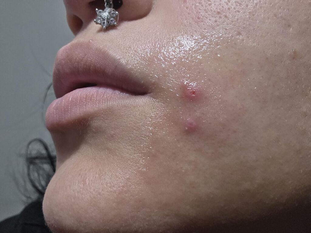 QRxLabs Salicylic & Glycolic Acid Acne Clearing Pads customer photo 1