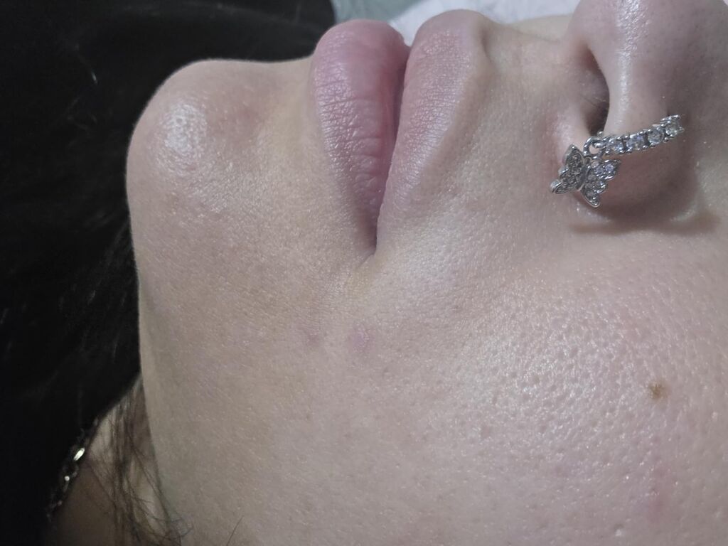 QRxLabs Salicylic & Glycolic Acid Acne Clearing Pads customer photo 2