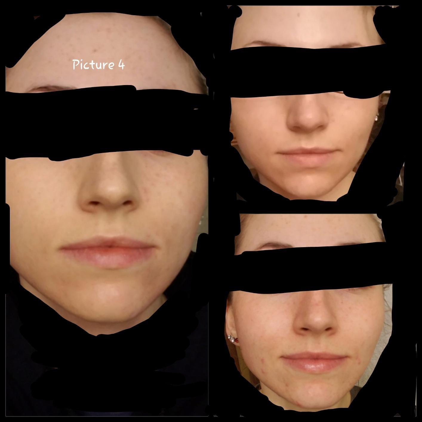 CeraVe Renewing Salicylic Acid Cleanser, Gentle Exfoliating Face Wash, 16oz customer photo 2