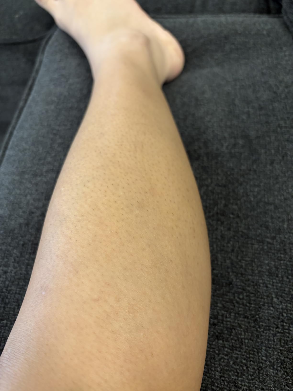Ubroo Laser Hair Removal Hair Reduction in 2 Session(Gold) customer photo 2